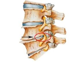 Příznaky a příznaky osteochondrosy