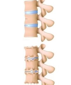 Příčiny osteochondrosy
