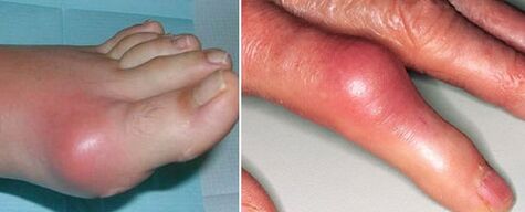 vzhled kloubů s artritidou