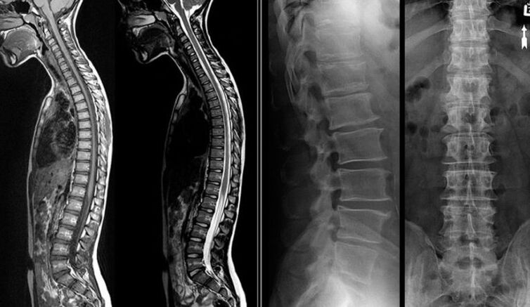 Rentgenové a MRI obrázky pro osteochondrózu