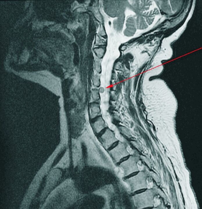 Intervertebrální kýla krční páteře na MRI