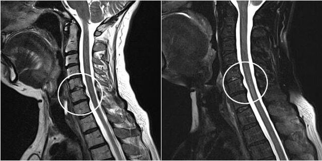 MRI krční páteře se známkami osteochondrózy