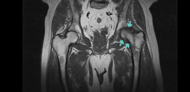 Degenerativně-dystrofické změny v kyčelním kloubu na MRI