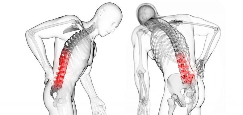 komplikace s cervikální osteochondrózou